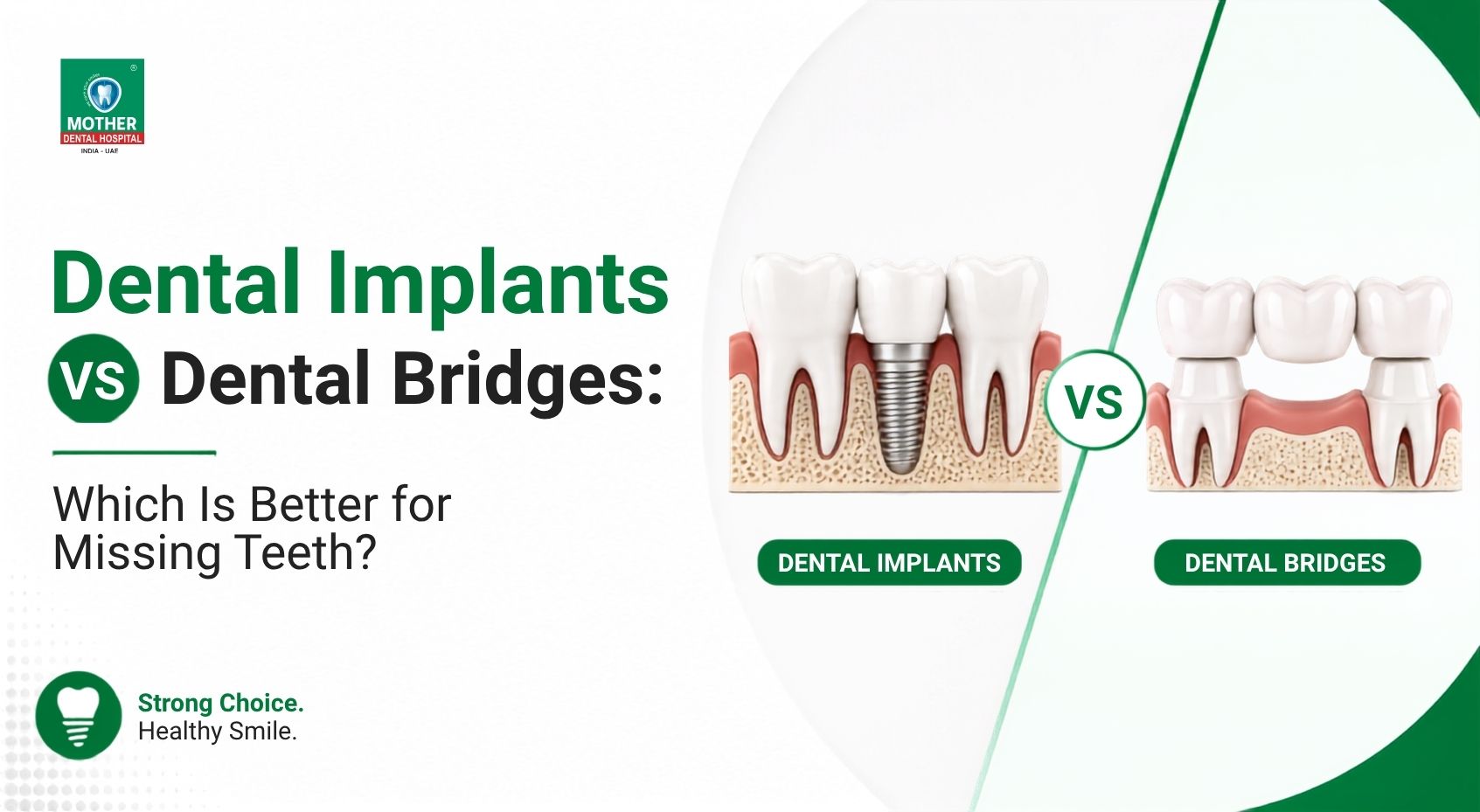 Dental implant Vs Dental Bridge