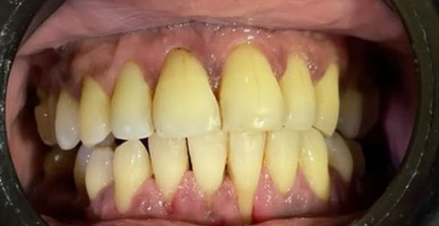 Mother Dental Hospital Teeth Treatment After Results