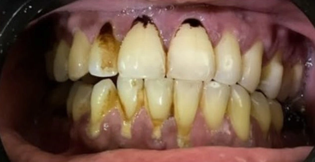 Mother Dental Hospital Teeth Treatment Before