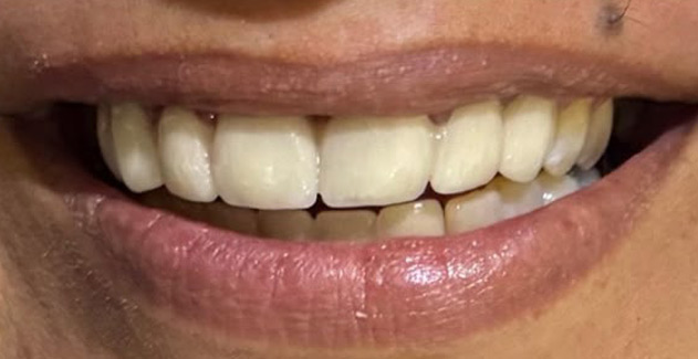 Mother Dental Hospital Teeth Treatment After Results
