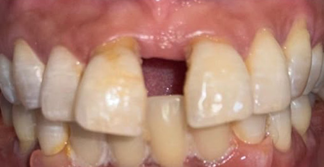 Mother Dental Hospital Teeth Treatment Before results