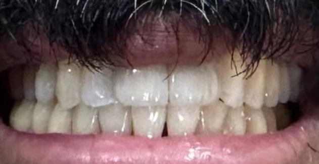 Mother Dental Hospital - Teeth Whitening Treatment After results.