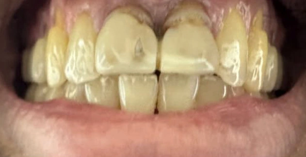 Mother Dental Hospital - Teeth Whitening Treatment Before results.
